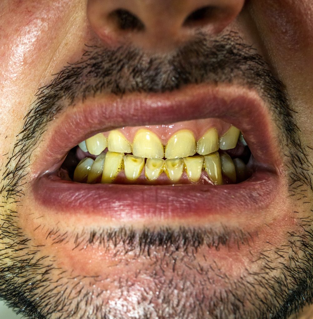 How Smoking Affects Your Teeth and Gums - Destin Dental Clinic
